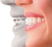 Invisalign provided by Rockeville Dentist Dr. Lisa Wang DMD, MS